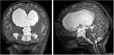 Case Report: Long-Term Tolvaptan Treatment in a Child With SIADH and Suprasellar Arachnoid Cyst